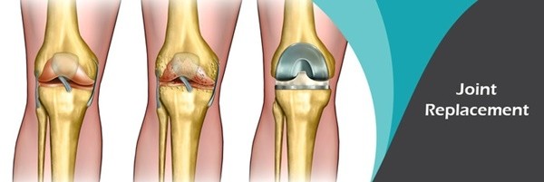 ▲ 퇴행성 질환인 골관절염의 치료는 약물 등의 치료방법에 의존하기 보다는 예방과 관리가 우선되어야 한다. 아무리 좋은 치료를 한다 하더라도 나빠지기 이전의 건강한 상태로 완벽하게 돌아가게 하긴 어렵기 때문이다.