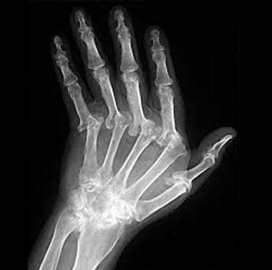 ▲  관절염이 만성기 증상으로 심한 열감이나 부종 및 통증이 줄어들고 운동이나 동작 시에 통증이 나타나거나 평소 관절이 시리거나 뻣뻣함을 호소하는 경우에는 관절을 보강하고 연골 생성을 촉진하는 기능을 발휘하는 약물로 구성된 처방을 사용한다.